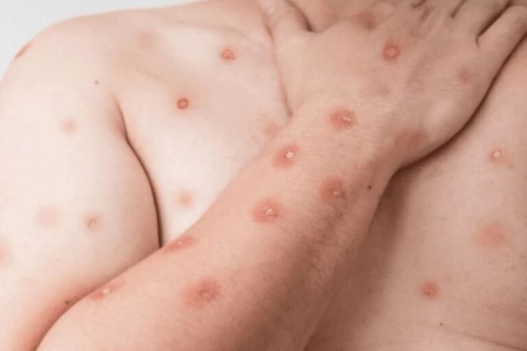 Mpox 2026: panorama da doença no Brasil e cuidados essenciais